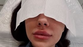 Intervenții „estetice” prin apartamente. Medicii trag un semnal de alarmă